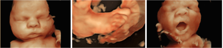 3D & 4D Ultrasound - San Diego Perinatal Center
