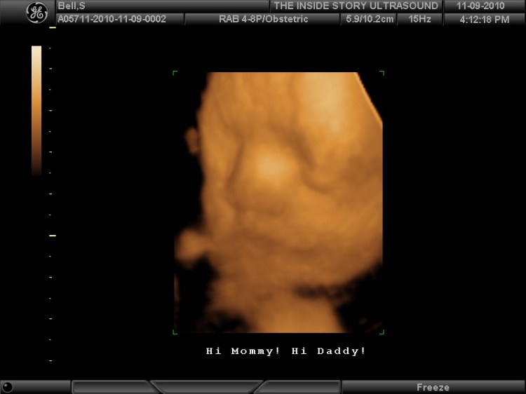 File:3D Ultrasound (5163520467).jpg - Wikimedia Commons
