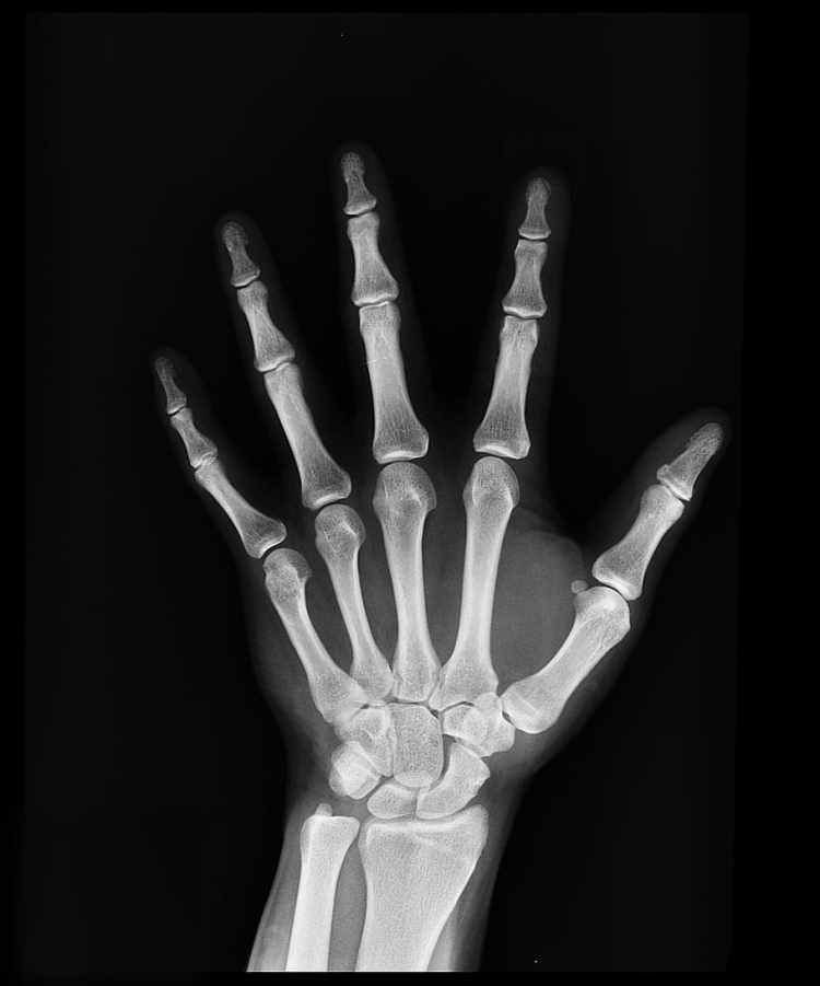 HD wallpaper: black-and-white, hand, bones, x-ray, xray, human hand, human body part - Wallpaper Flare