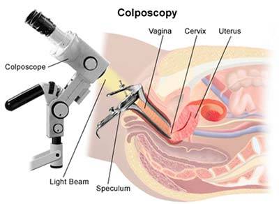 Colposcopy, Cervical Biopsy · Cervix Specialist · Dr. Mariz, Midtown NYC