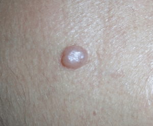 How Fast Nodular Melanoma Goes from Flat to Pencil Eraser Height - Scary Symptoms