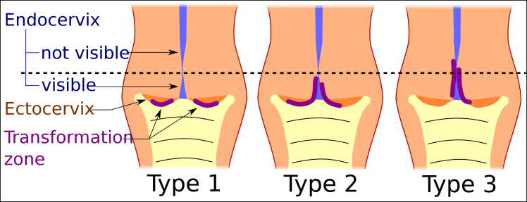 File:Transformation zone types.svg - Wikimedia Commons