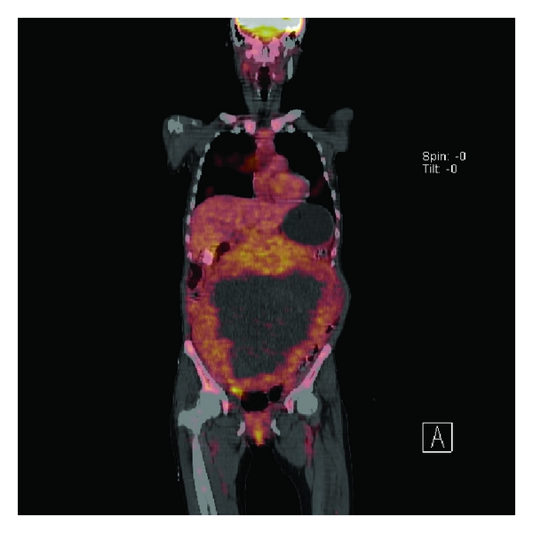A Patient with Advanced Gastric Cancer Presenting with Extremely Large ...