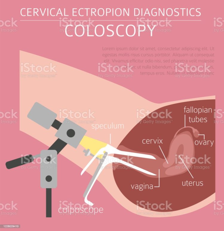 53 Colposcopy Illustrations & Clip Art - iStock
