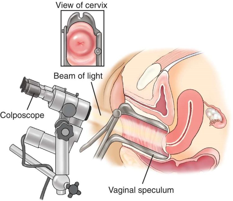 Colposcopy - Miami Beach OB/GYN Associates