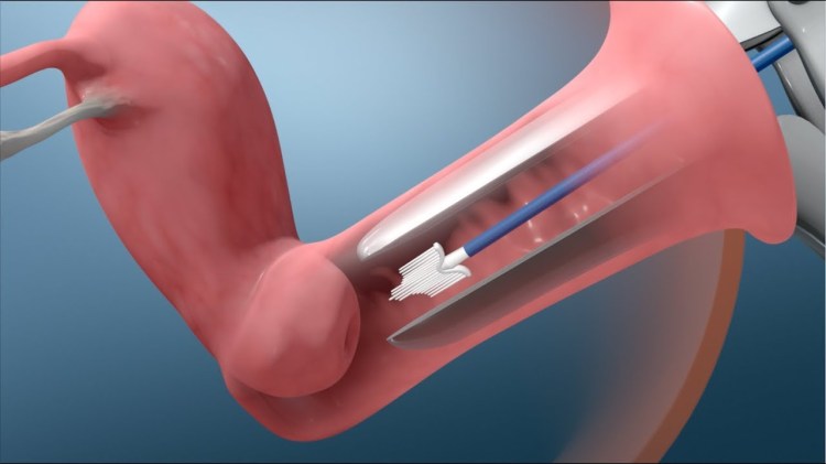hpv test