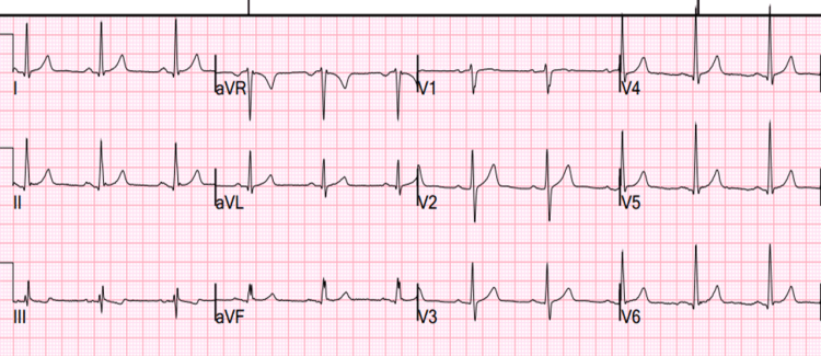 ekg